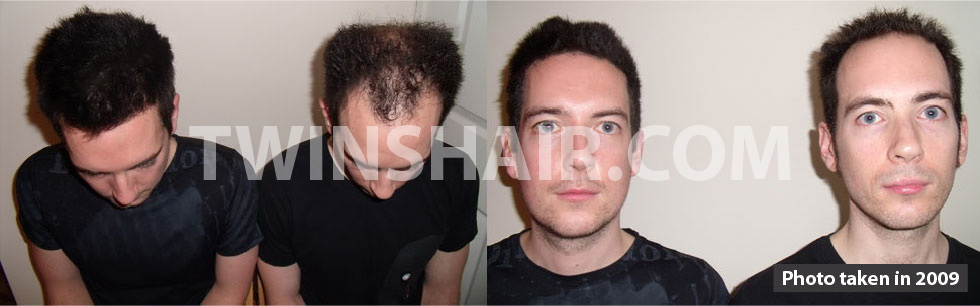 Twins Hair Loss - Identical Twins